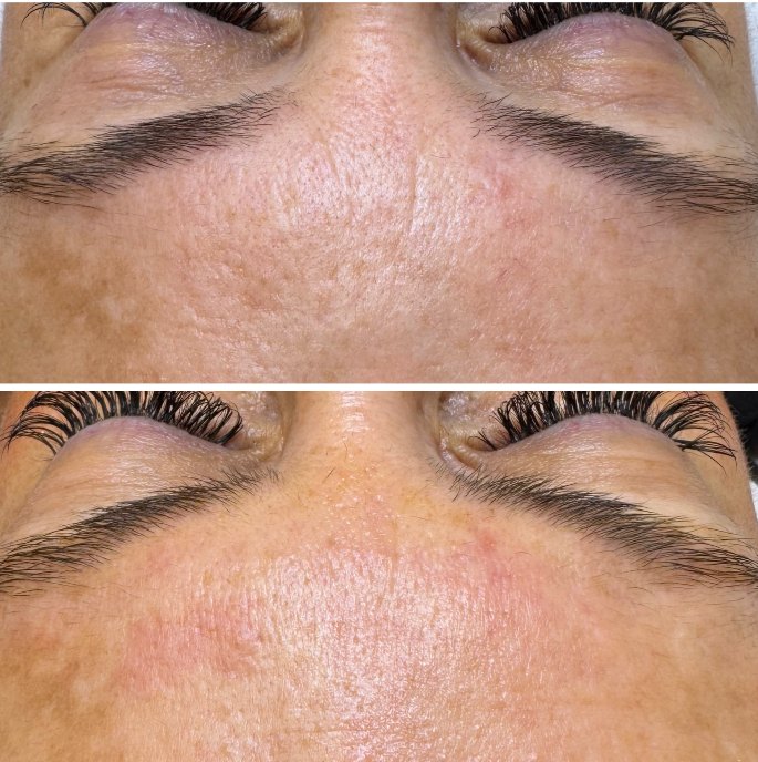 Antes y después de un tratamiento facial con Dermapen en Kalí Beauty Studio