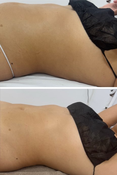 Antes y después de un tratamiento corporal de maderoterapia en Kalí Beauty Studio